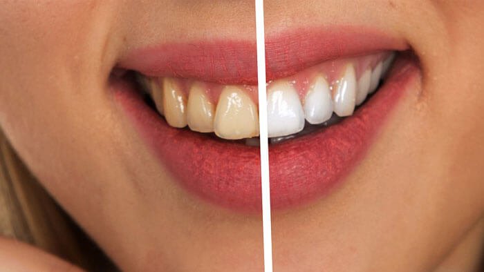 Teeth Cleaning